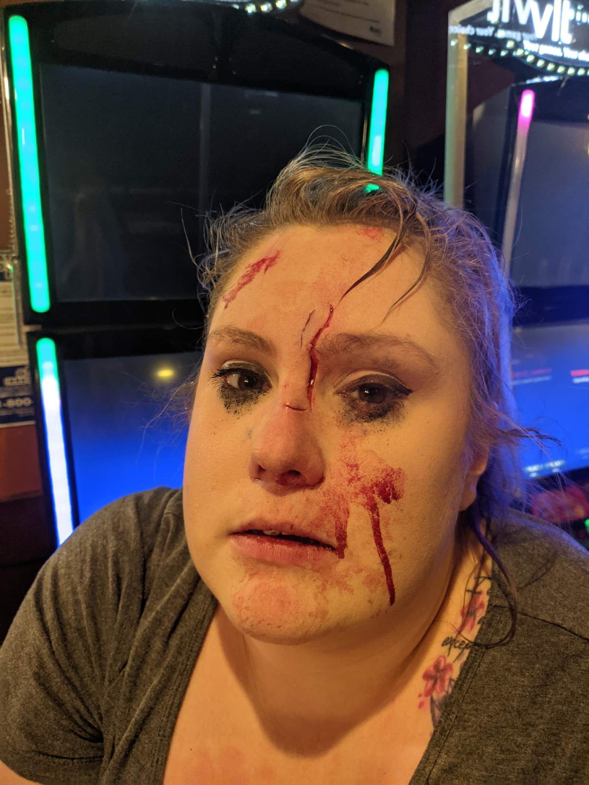 Erin Shaw’s lacerations following a confrontation at the Crown & Anchor Pub & Grill in Edmonton on Saturday, Nov. 28, 2020.