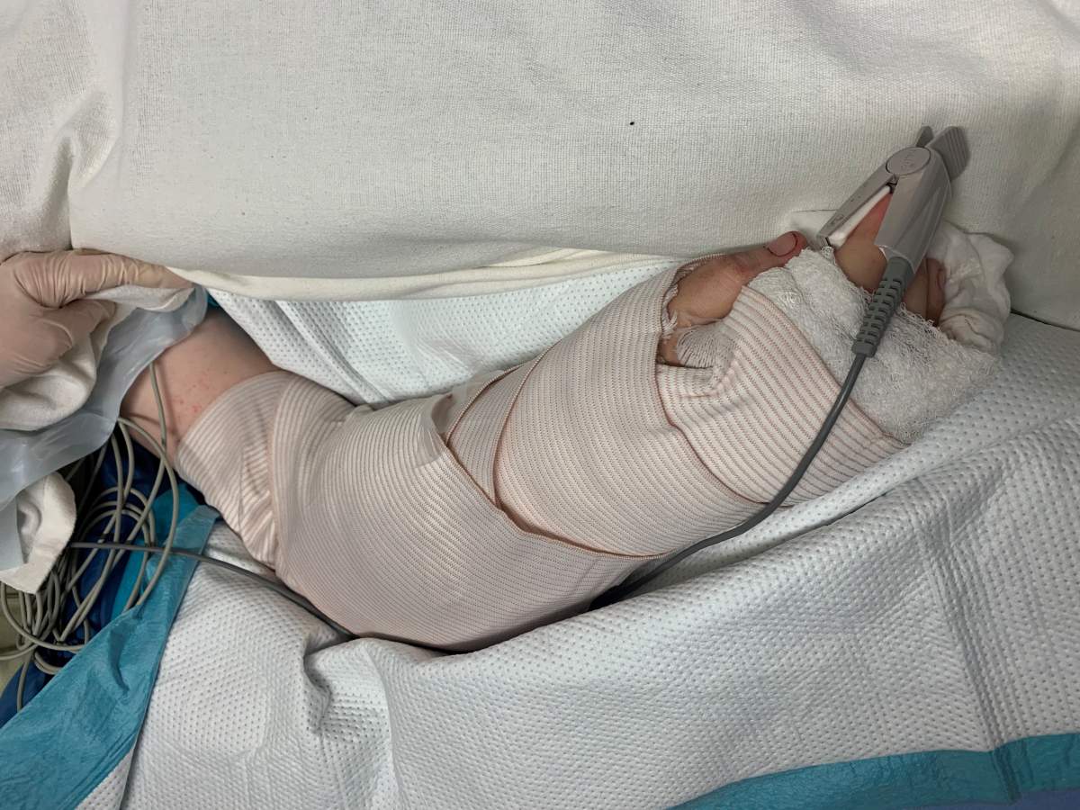 Haven Marshall’s right arm bandaged after surgery to reattach his forearm