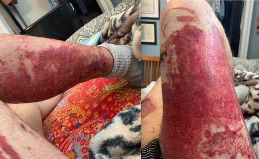 The chemical burns on Jake Hurl’s leg from the Teeple Terrace building collapse