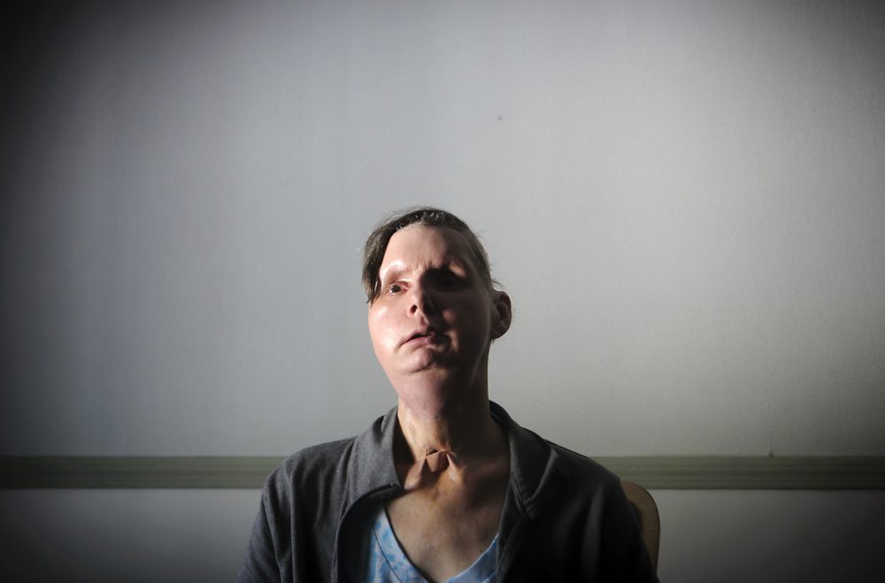 Charla Nash is pictured on March 21, 2012.