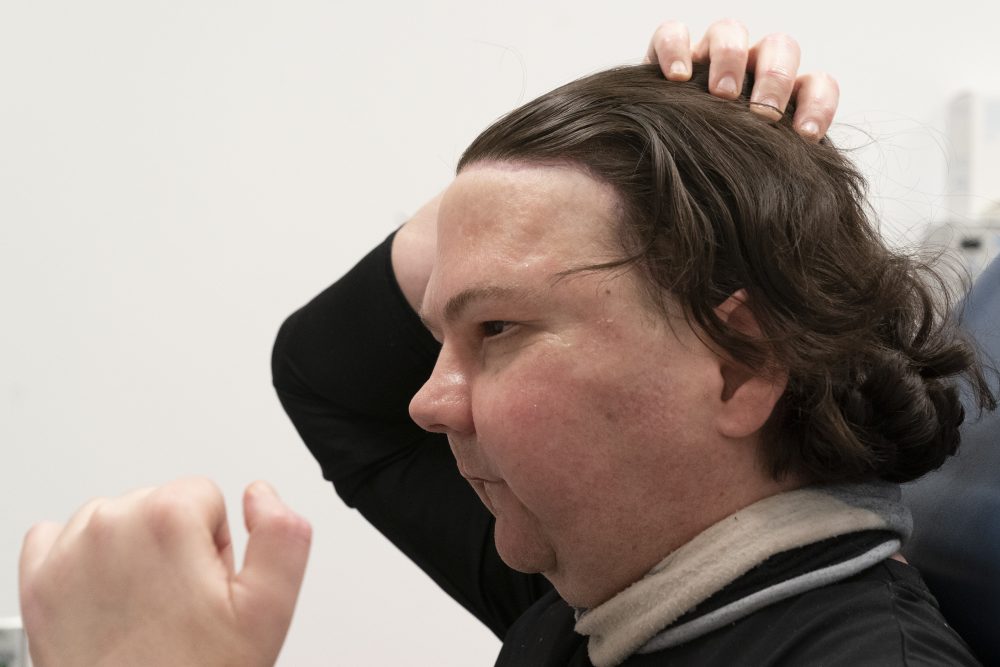Joe DiMeo demonstrates how he can arrange his hair, Monday, Jan. 25, 2021 at NYU Langone Health in New York.