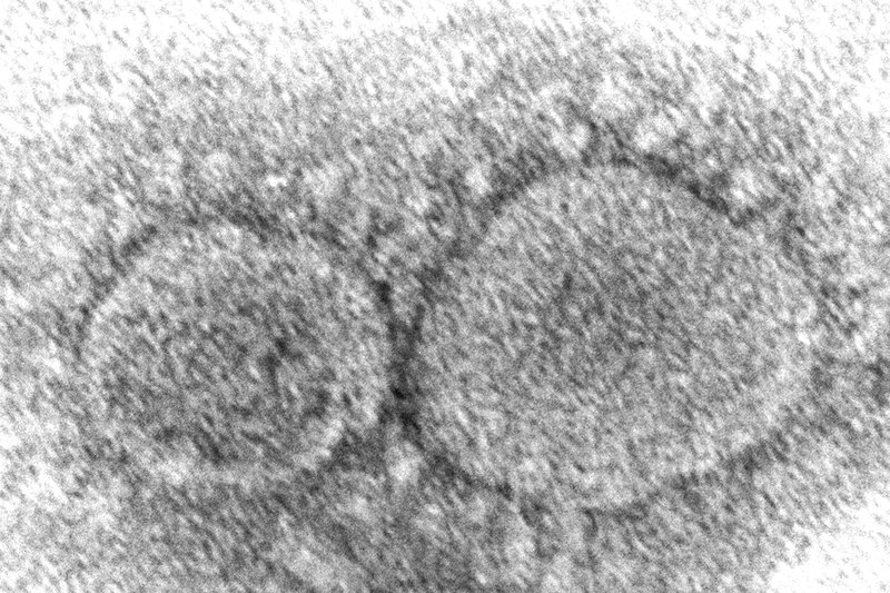 An electron microscope image showing SARS-CoV-2 virus particles which cause COVID-19.