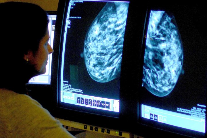 Risk of dying from breast cancer has dropped sharply since the 90s, research shows