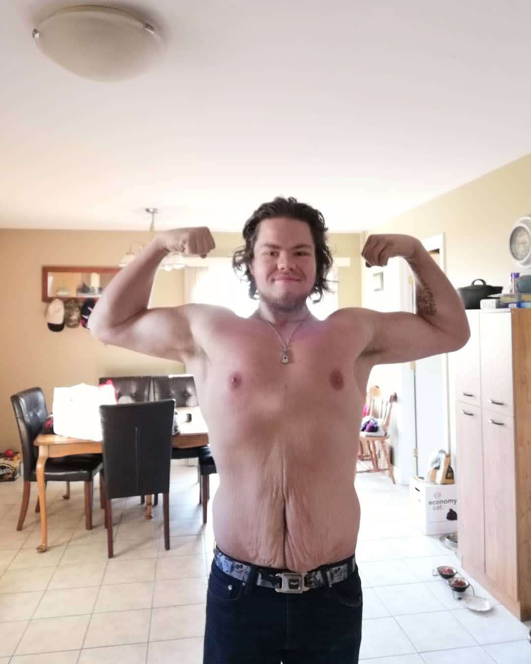 Moncton man asks province to help pay for skin removal surgery after dramatic weight loss - image