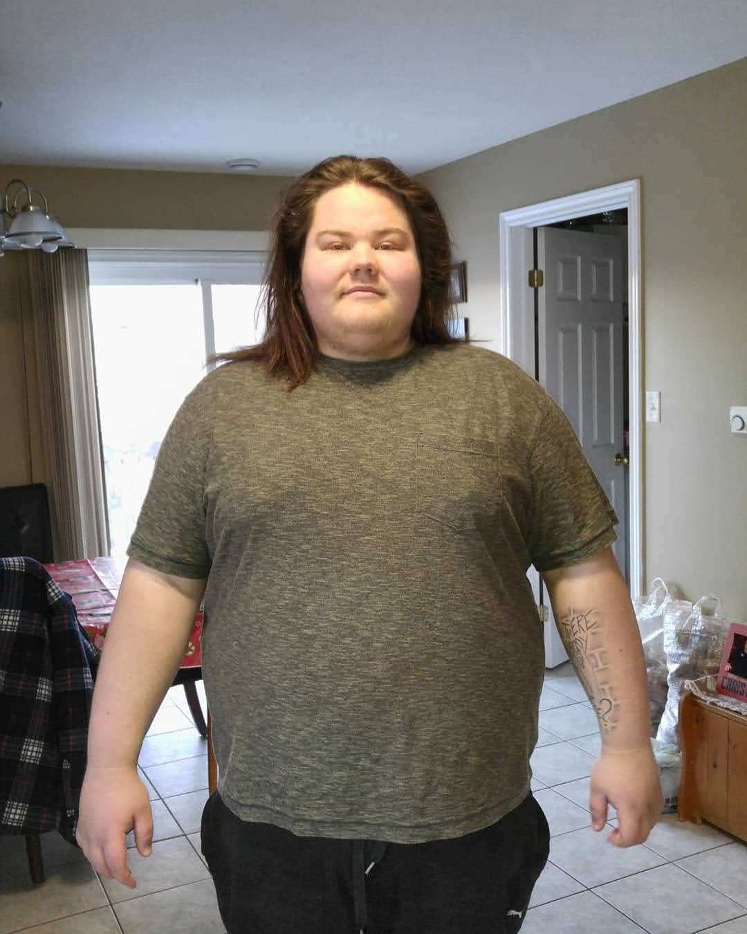 GETTING MY SKIN REMOVED, -145 LB WEIGHT LOSS