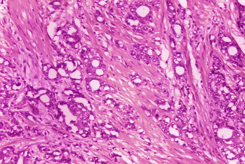 This 1974 microscope image made available by the Centers for Disease Control and Prevention shows changes in cells indicative of adenocarcinoma of the prostate. In results released Thursday, June 3, 2021 by the American Society of Clinical Oncology, doctors are reporting improved survival in men with advanced prostate cancer from an experimental drug that delivers radiation directly to tumor cells. ()
.