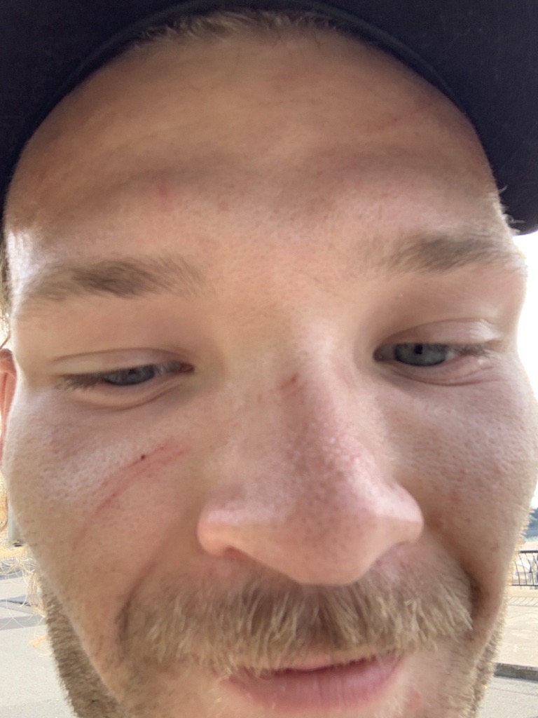 Jets fan Alex Wojakowski says these injuries were caused by Montreal Canadiens supporters who attacked him after a game.