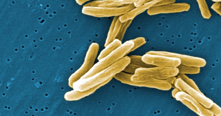 Tuberculosis outbreak in 2 northern Saskatchewan communities