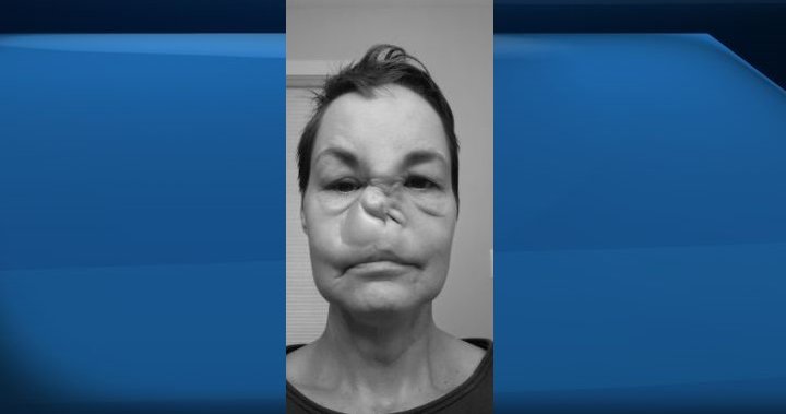 COVID-19: Saskatchewan woman scared after surgery in Alberta cancelled