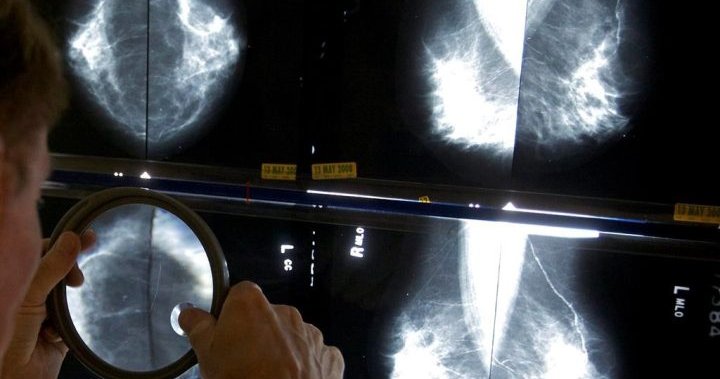 AI proven to safely improve breast cancer detection accuracy, study finds