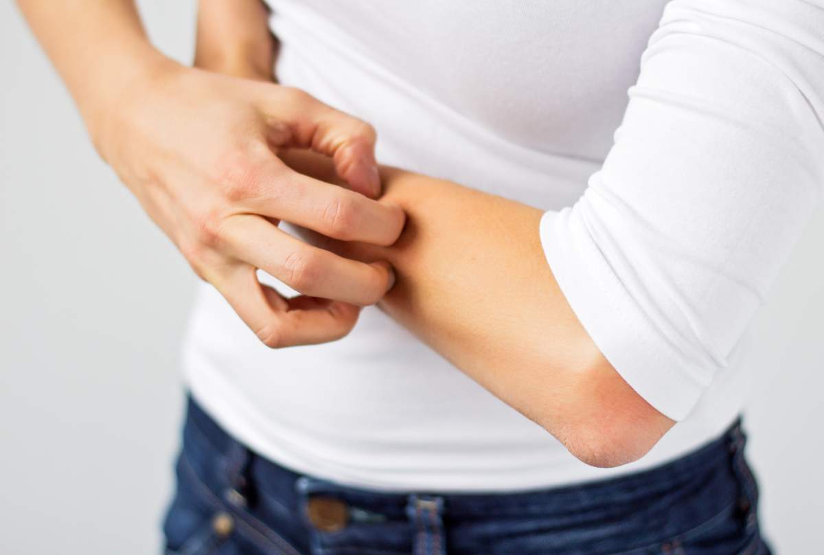 Eczema Society of Canada