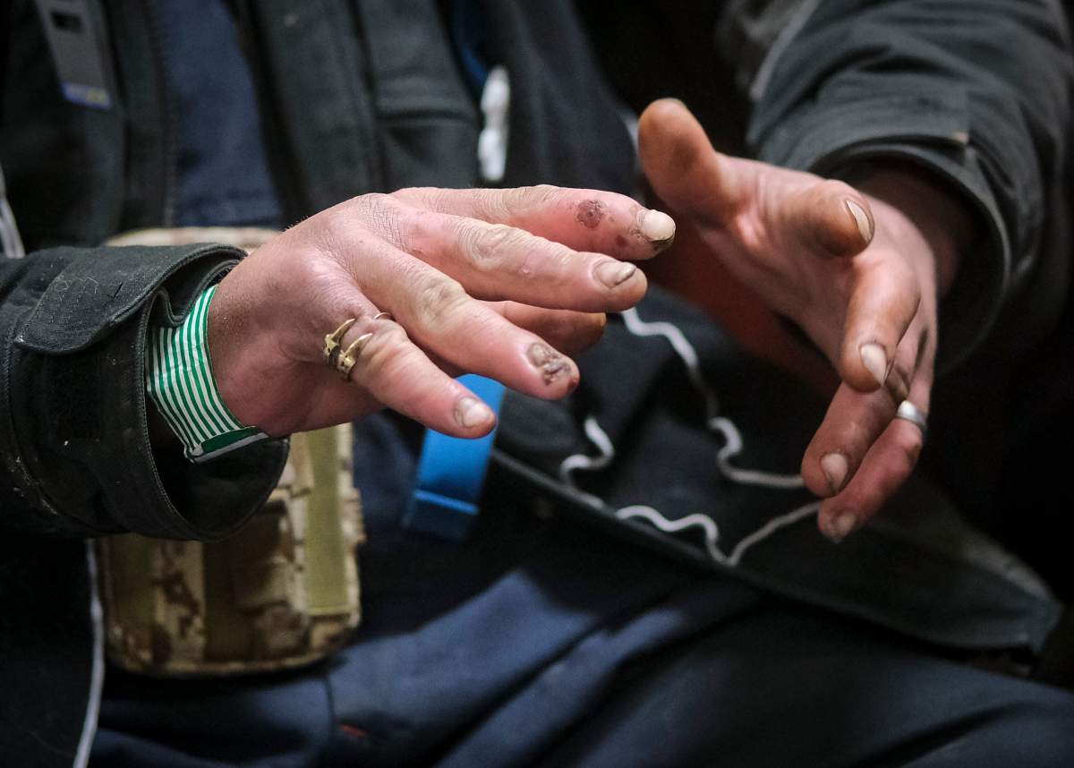 Dakota Casey, who is homeless, displays his frostbitten hands at an outreach facility on a -20C night in Calgary, Alta., Tuesday, Dec. 14, 2021.