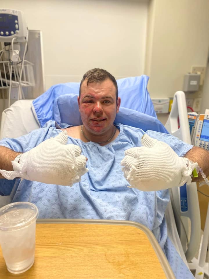 Jesse Humphrey suffered major burns in a house fire in Strathcona County.