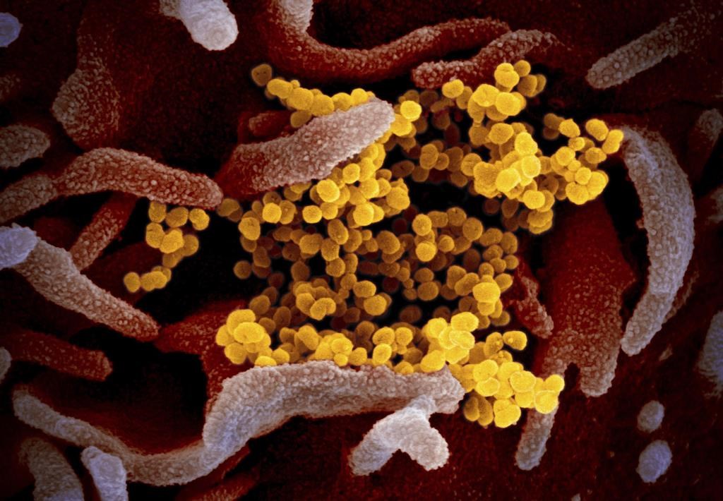 This undated electron microscope image made available by the U.S. National Institutes of Health in February 2020 shows the Novel Coronavirus SARS-CoV-2, yellow, emerging from the surface of cells, pink, cultured in the lab.