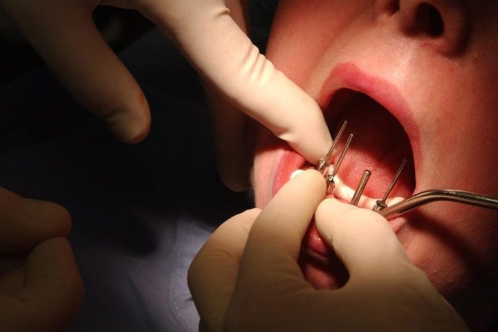 Dentist sued for performing 4 root canals, 8 crowns, 20 fillings in one day