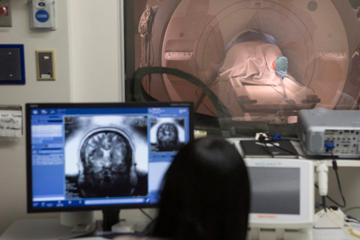 An image of Sky Zazlov's brain is displayed on a monitor screen as she lies in a MRI machine for a focused ultrasound procedure, at Toronto's Sunnybrook Hospital on Tuesday, May 1, 2018. The trial is a North American first in the treatment of depression, which uses high frequency ultrasound waves to reach deep part of the brain. THE CANADIAN PRESS/Chris Young.