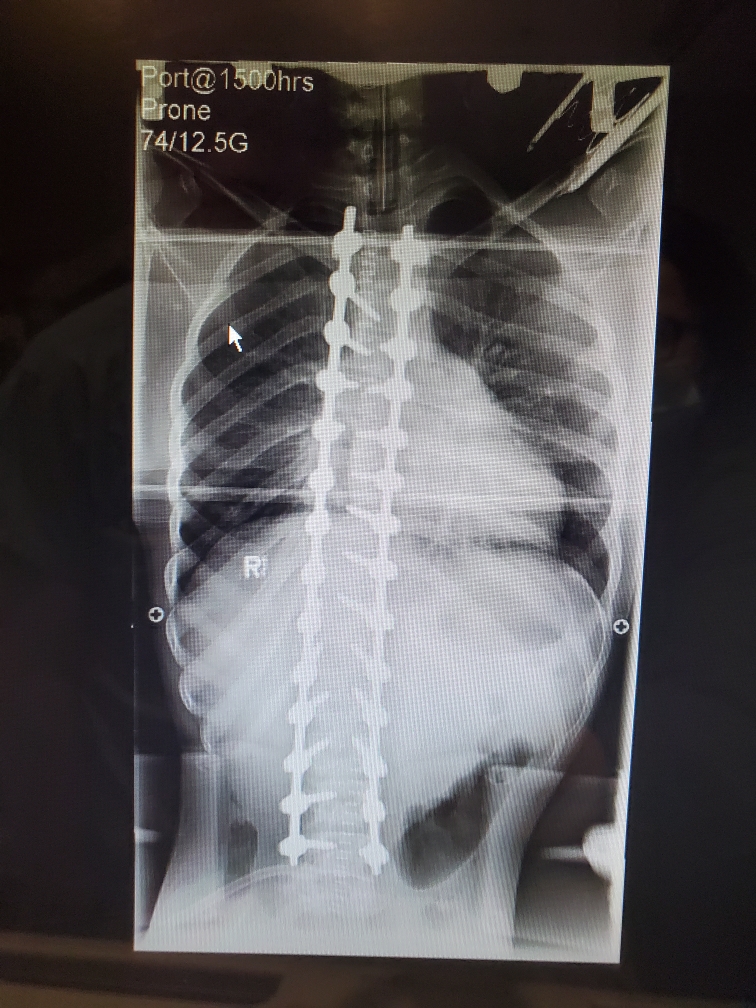 Devin Gallant post surgery