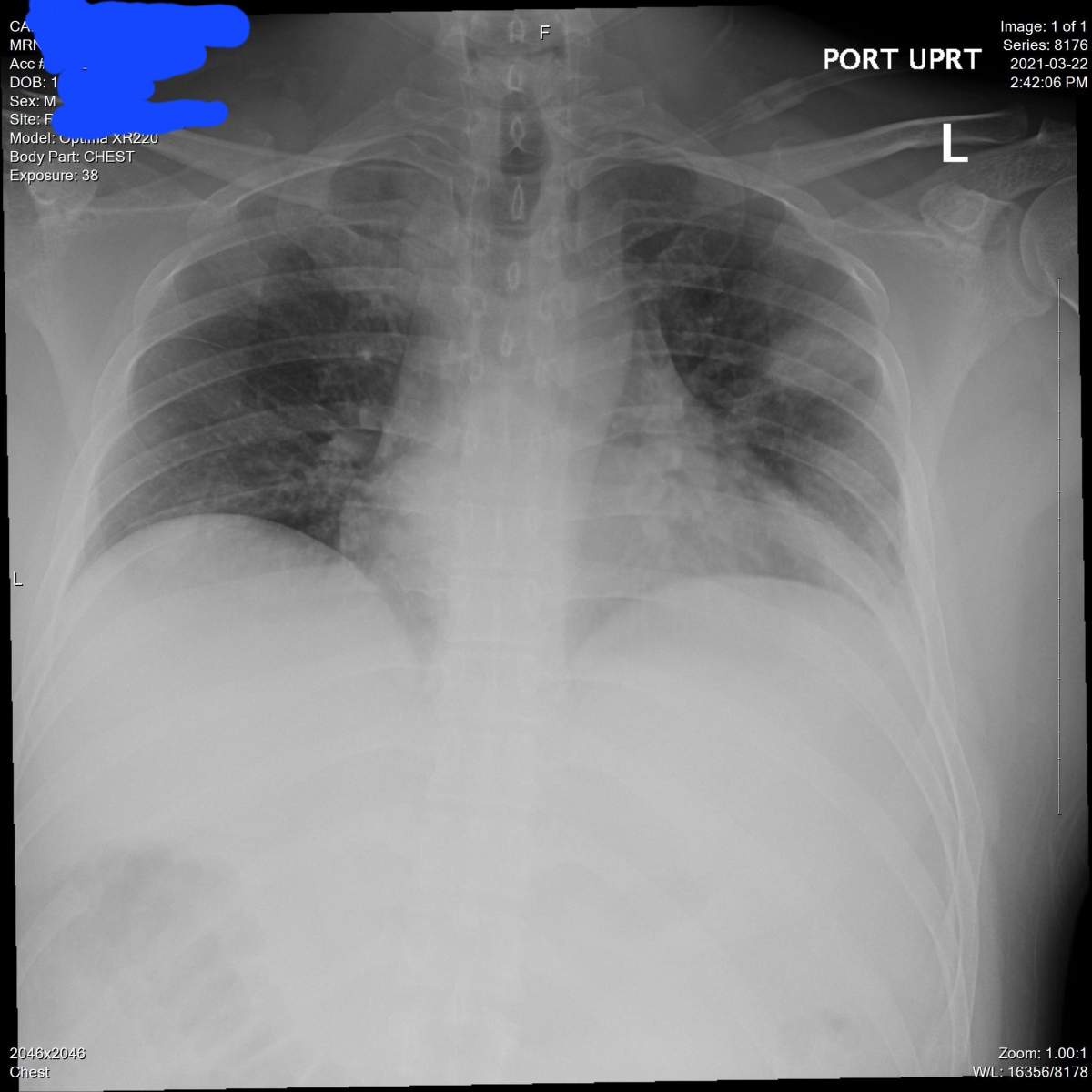 This X-ray image of Matthew Cardinal’s lungs was captured on March 22, 2021.