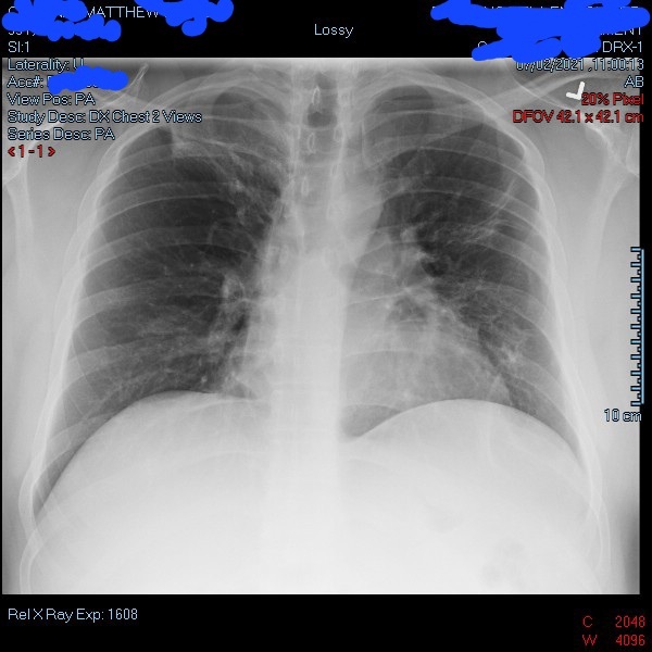 This image was taken months after Cardinal was discharged from the hospital following his recovery from COVID-19. This X-ray shows his lungs do not have as much of a cloudy look to them compared to X-rays taken when he was admitted to hospital on March 22, 2021.
