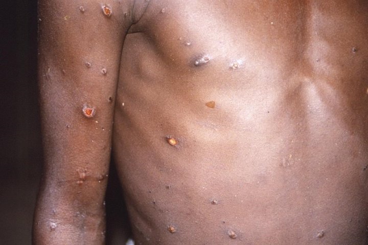 3 more monkeypox cases confirmed in Quebec, bringing Canadian total to 5