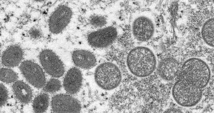 U.S. confirms monkeypox case in man who recently travelled to Canada  | Globalnews.ca
