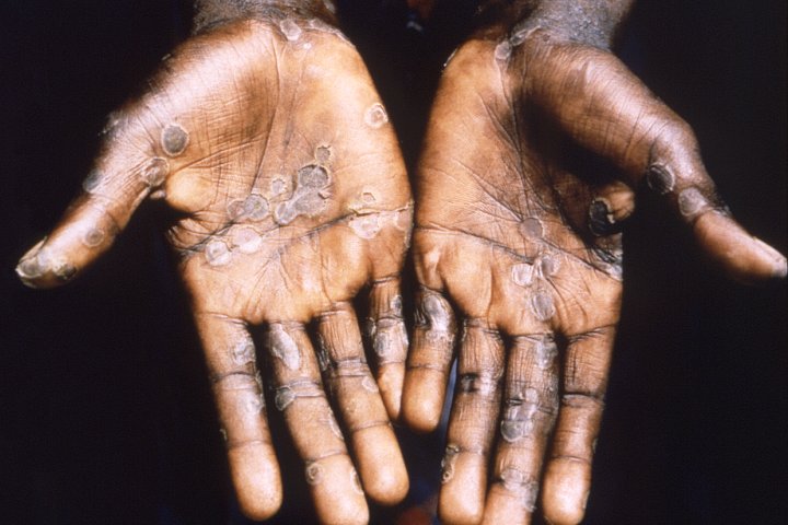 WHO working on more monkeypox guidance as cases spike, adviser says