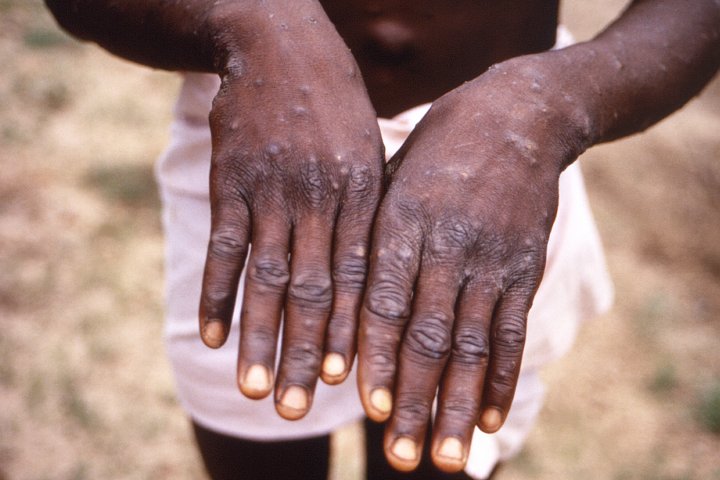 Monkeypox spread ‘unusual’ but risk to Canadians is ‘low,’ officials say