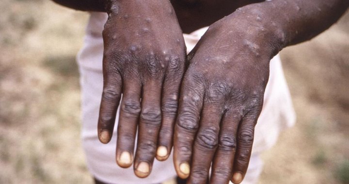 Monkeypox: U.S. to declare health emergency amid outbreak, sources say