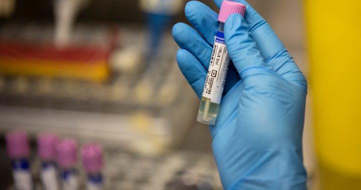 Second case of monkeypox confirmed in Saskatchewan
