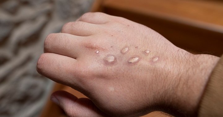 Monkeypox cases in Canada rise by 59% in 9 days