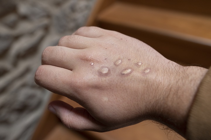 Monkeypox cases in Canada rise by 59% in 9 days
