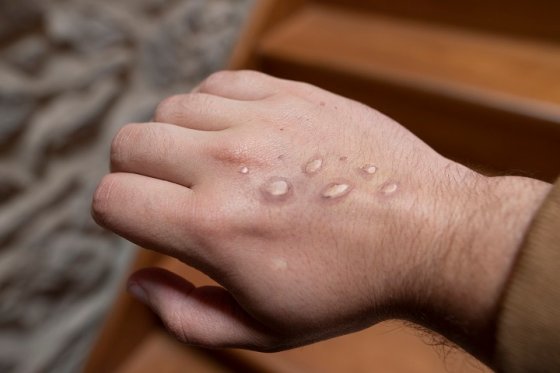In this undated photo, Monkeypox vesicles in a hand.
