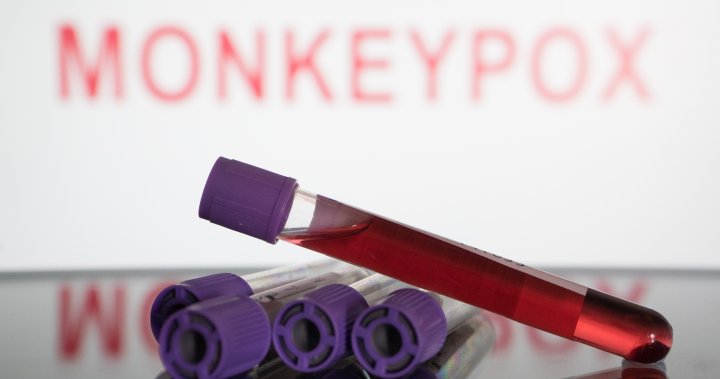 Saskatchewan reports first confirmed case of monkeypox