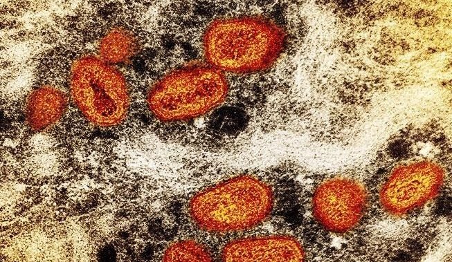 Monkeypox: 890 cases reported in Canada, majority in Ontario
