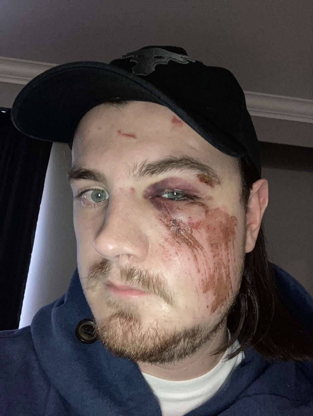 Patrick Bélanger shows injuries sustained during a trip to British Columbia. Bélanger of Quebec City says he was denied surgery for a week after he fell and broke his jaw and cheekbone and ended up in the emergency room of a hospital in B.C., where a surgeon told him he couldn't do the operation because Quebec "doesn't pay.".