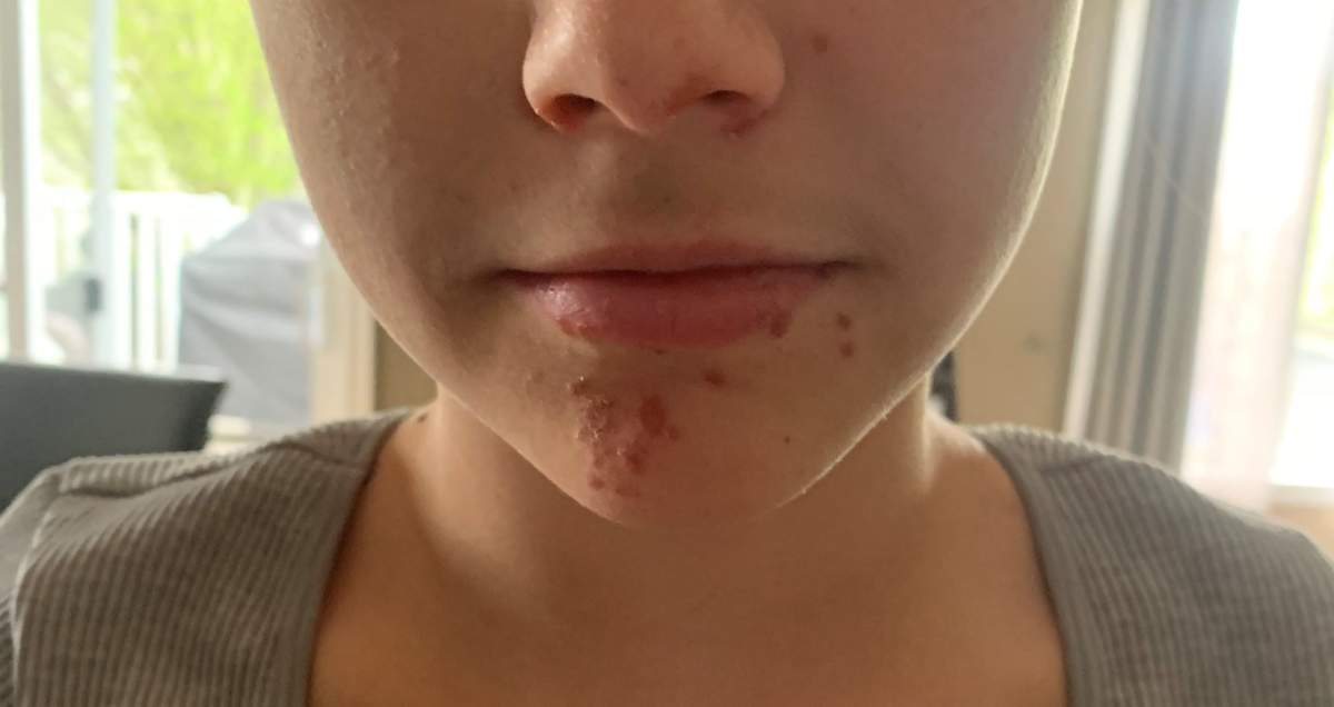 A child with hand-foot-and-mouth disease in Edmonton
