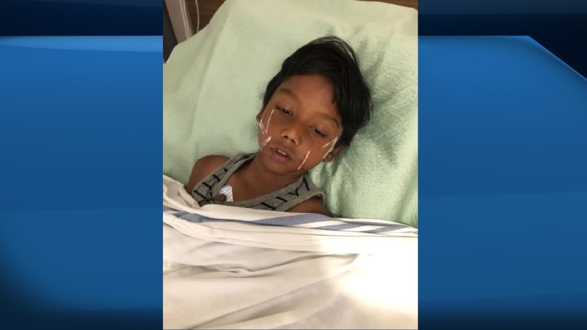 Saihan Refat recovers after being bitten by a dog on Wednesday.