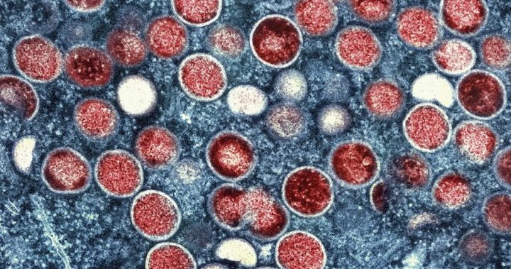 Monkeypox death reported in California, believed to be 1st in U.S.