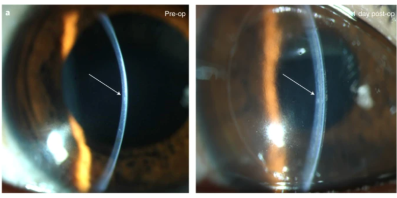 Eye implant made from pig skin restored sight in blind people, according to study