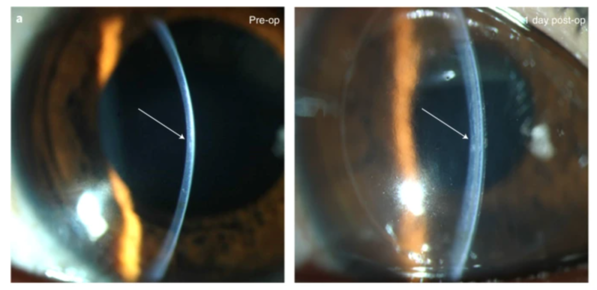 Photograph of a pre-operation and post-operation eye ball from a new study in Nature Biotechnology that found that pig skin implants can restore vision to the blind.