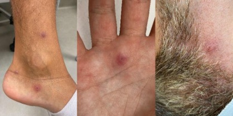 Man tests positive for COVID, monkeypox and HIV all at the same time