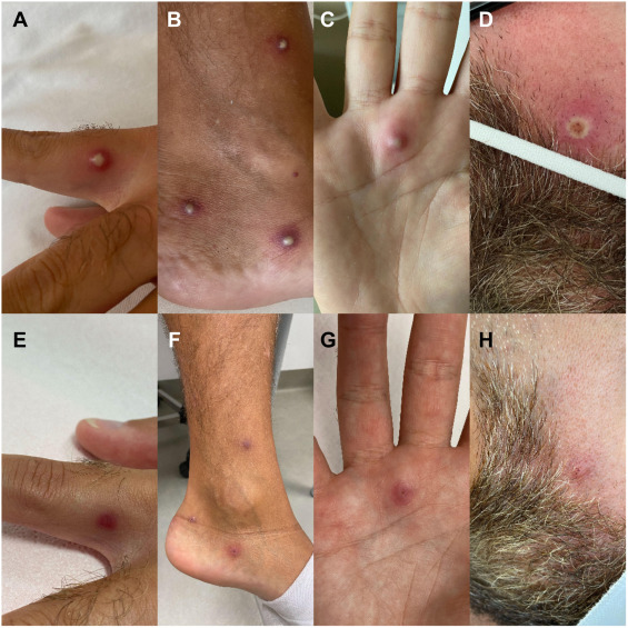 A photo shared by the Journal of Infection shows various stages of the patient’s monkeypox sores. Panels A to D show infection within the first 16 days. Panels E to H show lesions that have begun to heal.