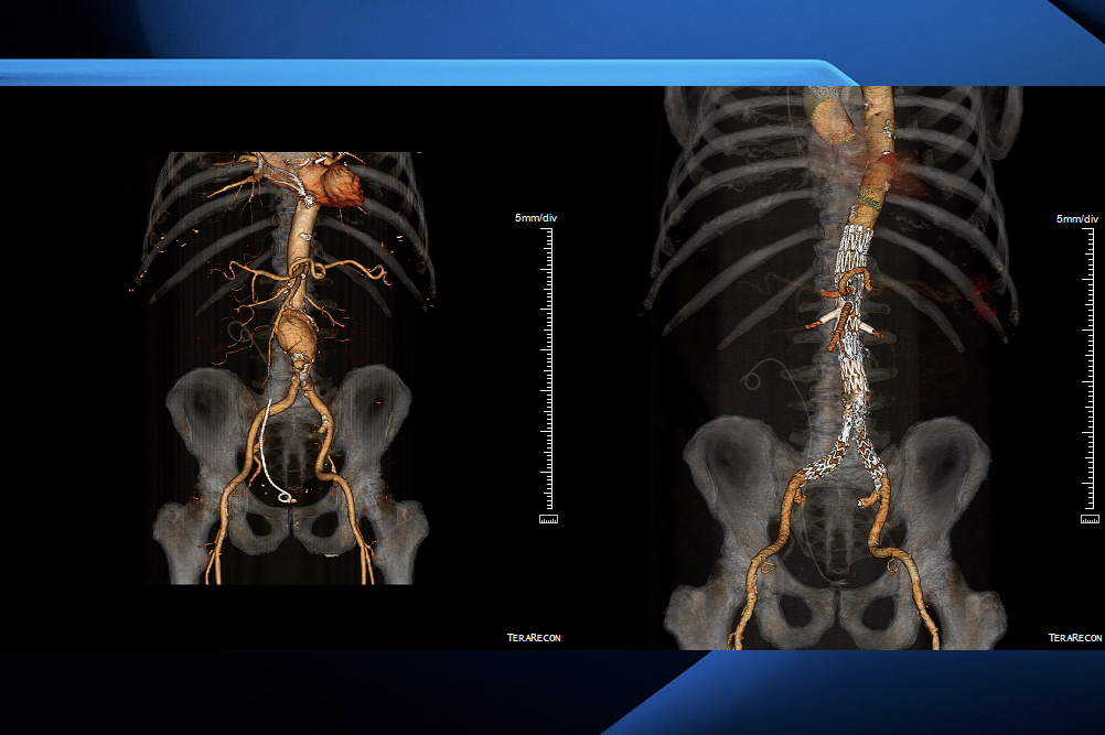 Images released by London Health Sciences Centre showing an aortic aneurysm before EVAR and the same area after.