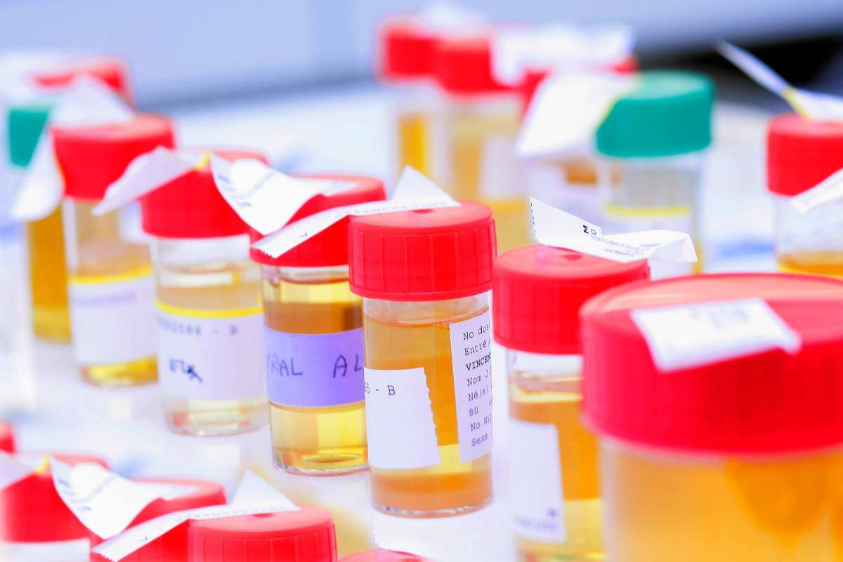 File photo of urinalysis samples.