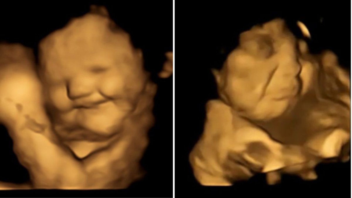 Two ultrasound scans, one showing a fetus that appears to be smiling, the other a fetus that appears to be frowning.