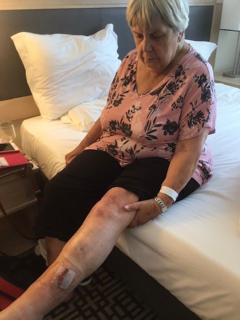 Scanlon suffered a cut to her leg and required stitches.