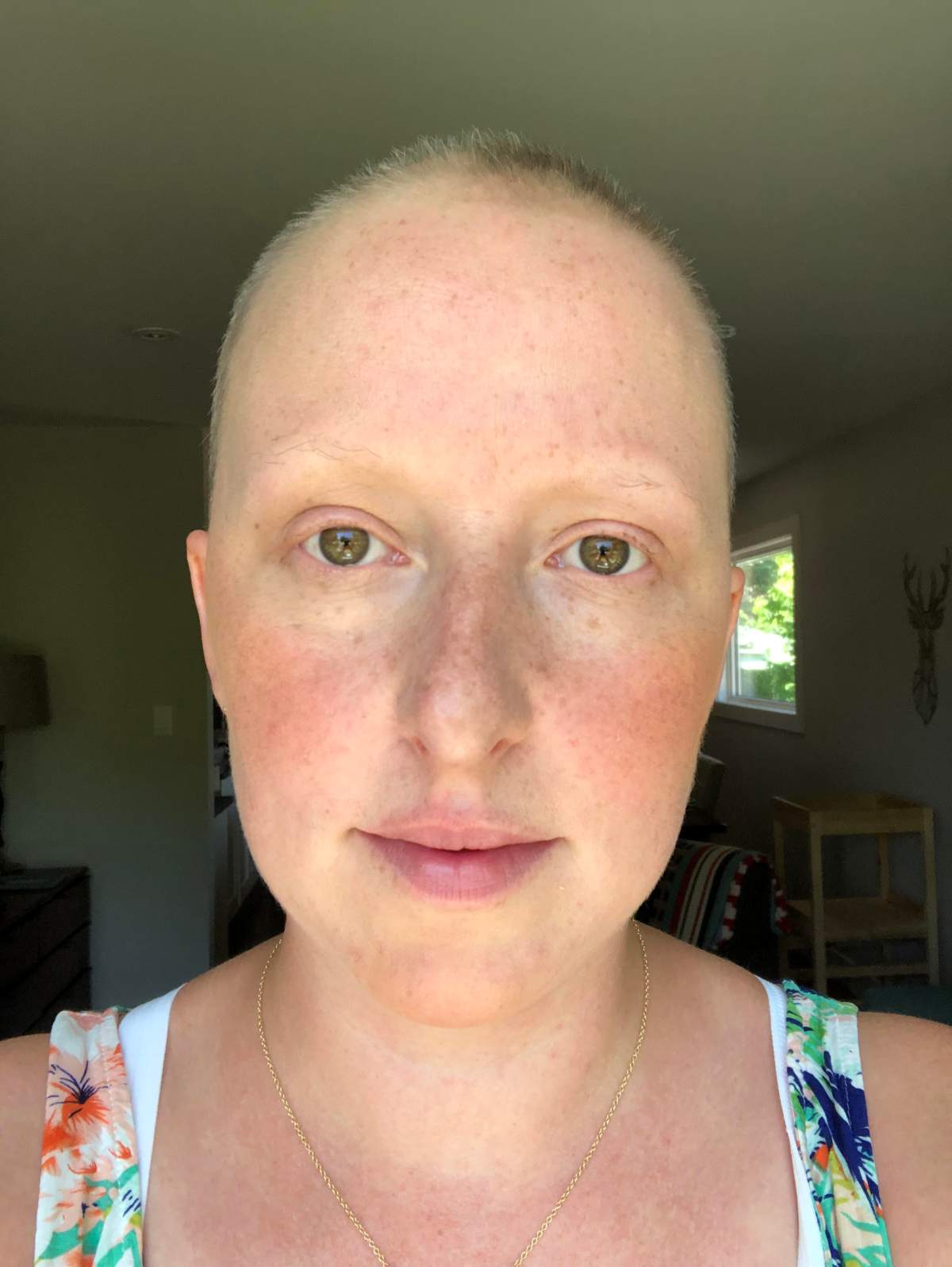 At my lowest point, both physically and mentally, during my initial cancer treatment in 2019. I had lost all my facial hair and was very sick from the accumulated chemotherapy.