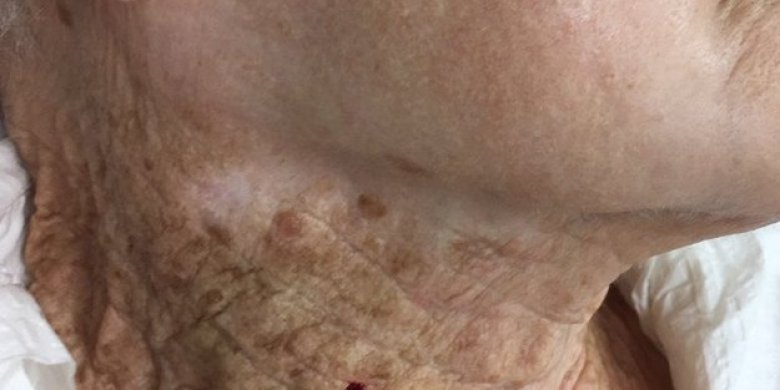 Don't skip the neck! Stark photo shows why sunscreen should extend past the face