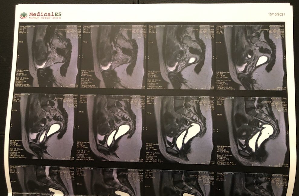 MRI scans of a Canadian endometriosis patient's pelvic area.