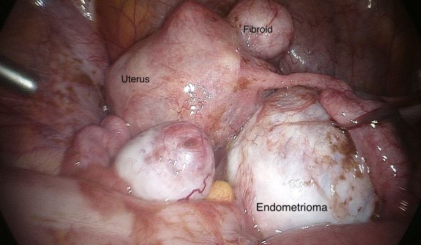 A complex case of endometriosis is seen in the pelvis of a Canadian patient.